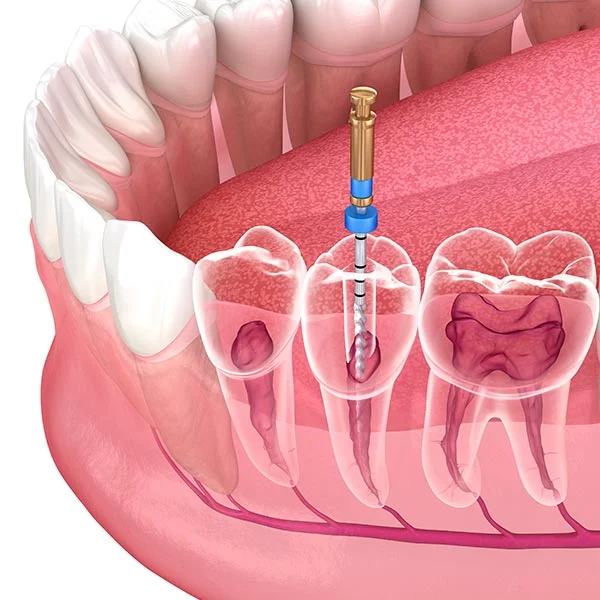 para que sirve una endodoncia