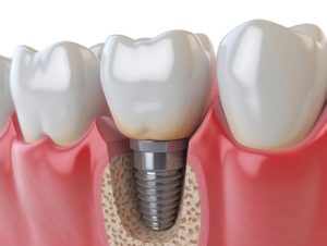 implantes dentales