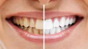 cuanto dura un blanqueamiento dental