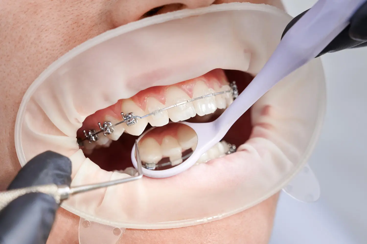 Dentista revisando la colocación de brackets tradicionales durante tratamiento ortodóntico