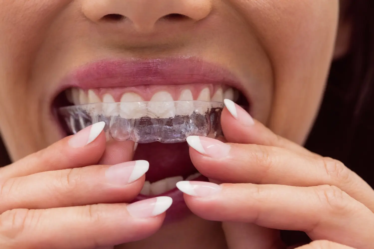Mujer colocando alineador dental transparente