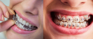 Invisalign vs brackets: diferencias visibles entre ortodoncia invisible y fija