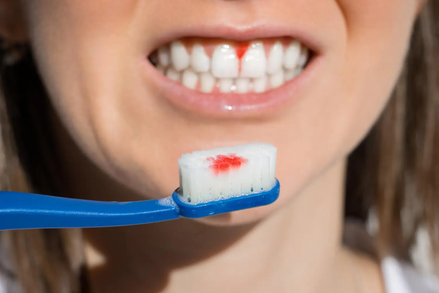 encías inflamadas con sangre tras cepillado